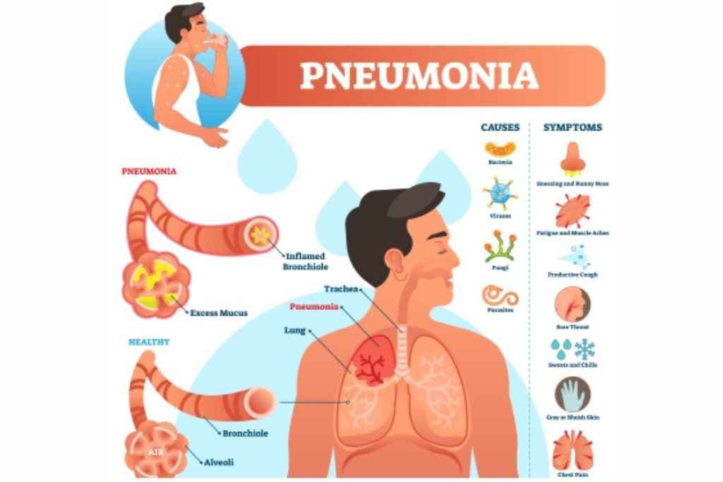 What is mysterious pneumonia?