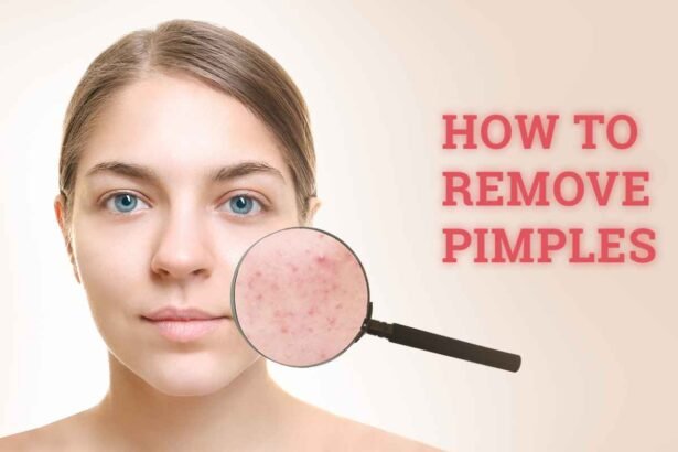 How do I clear acne on my face